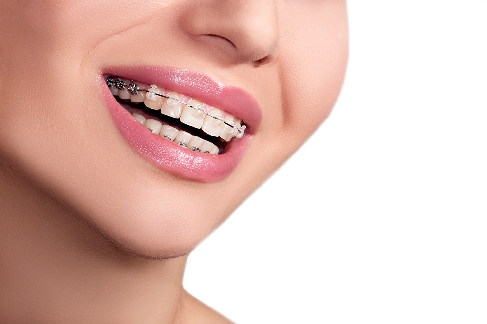 Por que a reabilitação oral é um investimento na sua qualidade de vida? 8 aparelho dental
